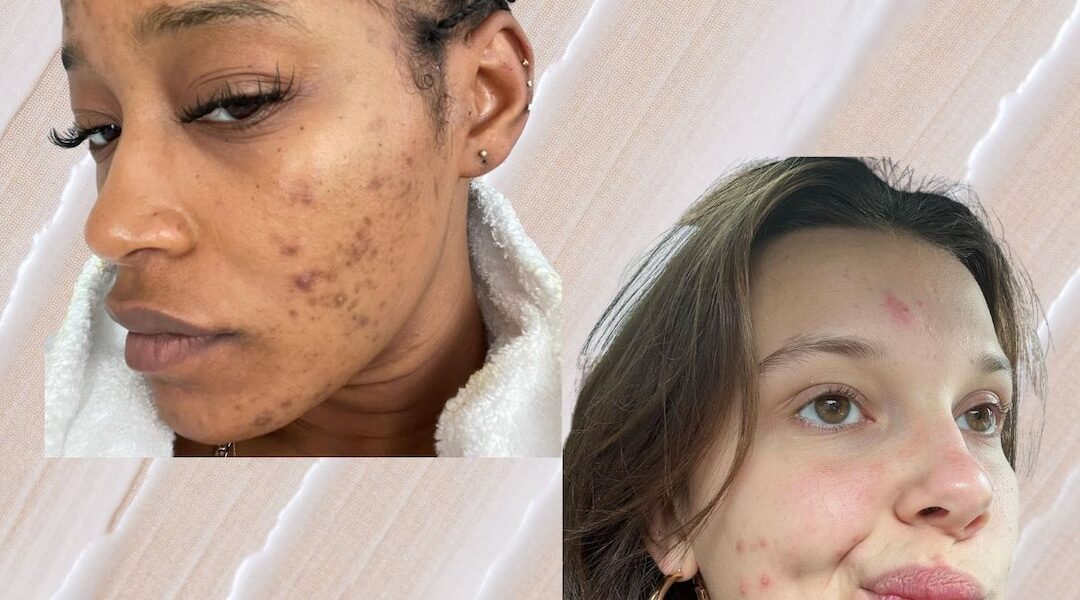 All Of Your Burning Questions About Adult Acne, Answered