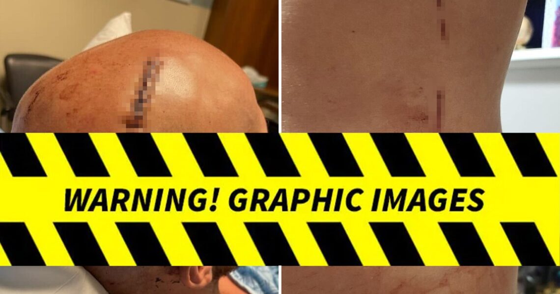 Man Stabbed In 2 Cold Scorpio Fight Needed Staples, Stitches, Horrific Pics Show