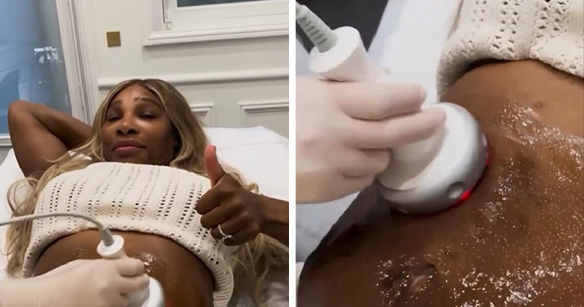 Serena Williams Gets Tummy-Tightening Procedure For Pre-Kids Confidence