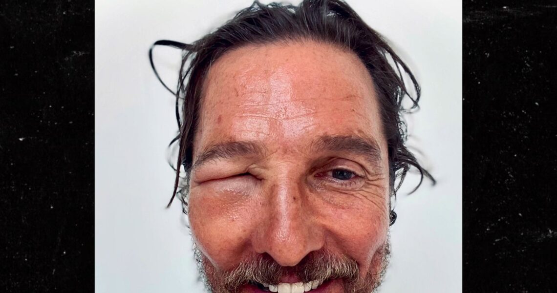 Matthew McConaughey Shares Selfie Of Bee Sting, Eye Swollen Shut