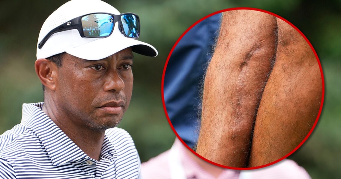 Tiger Woods Shows Off Gnarly Leg Scars Three Years After Car Crash