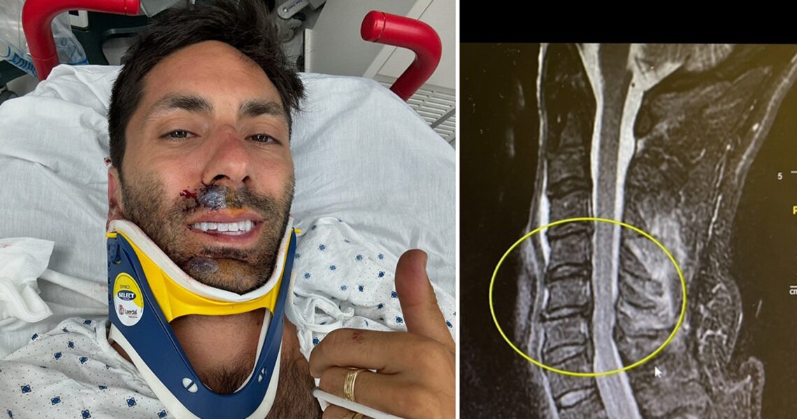 Nev Schulman Breaks Neck in Bike Accident