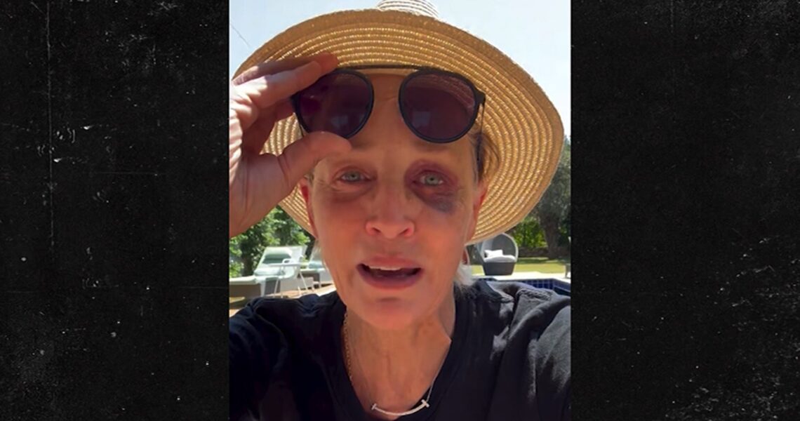 Sharon Stone Reveals How She Got Her Black Eye During Turkish Getaway